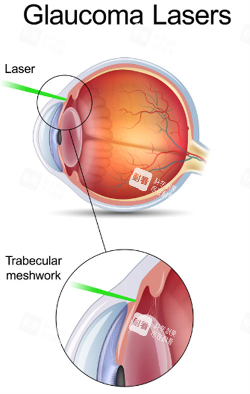 青光眼出現的問題
