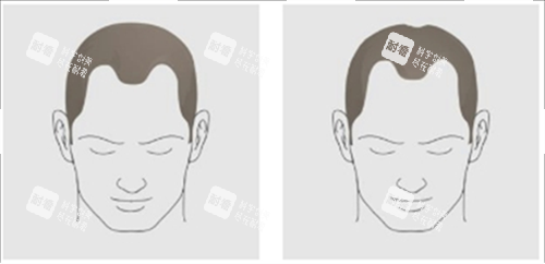 發(fā)際線后移類型