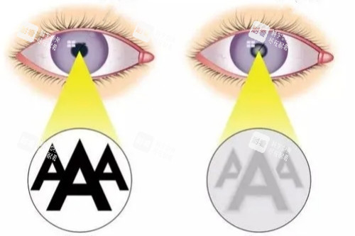 白內(nèi)障與正常眼睛視物卡通對(duì)比圖