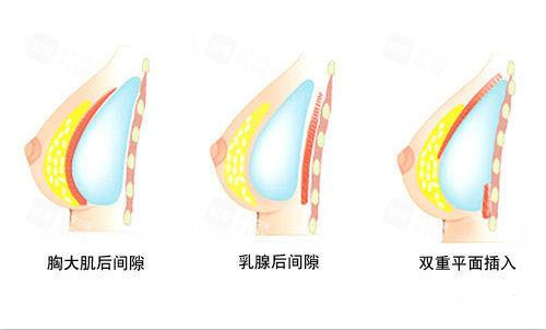 西安藝星竇璽院長豐胸技術(shù)好嗎？真實病例+價格+預(yù)約方式全解析
