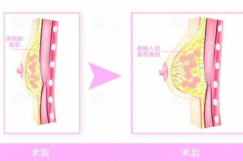 自體脂肪隆胸圖片