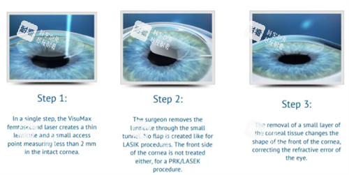 眼睛近視手術(shù)的過程