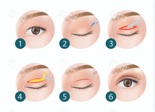 雙眼皮手術(shù)過(guò)程圖