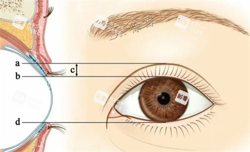 PARK法雙眼皮素材