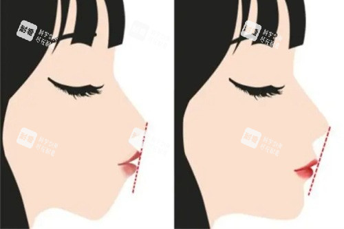 正頜手術(shù)前后的對比圖