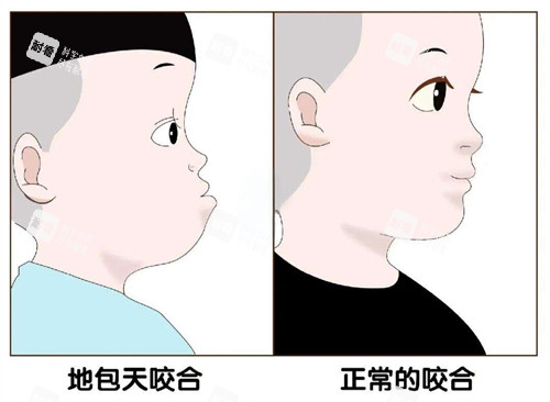 地包天和正常對比圖