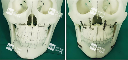 正頜手術(shù)手術(shù)原理展示圖 正頜手術(shù)手術(shù)原理展示圖