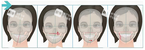 正頜手術(shù)手術(shù)步驟展示動(dòng)畫圖 正頜手術(shù)手術(shù)步驟展示動(dòng)畫圖