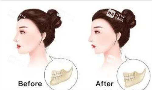 正頜手術(shù)后的成效圖片 正頜手術(shù)后的成效圖片