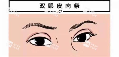 雙眼皮肉條痕圖