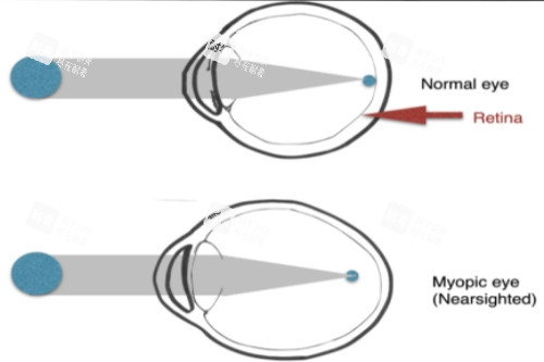 正常眼與近視眼對比 正常眼與近視眼對比
