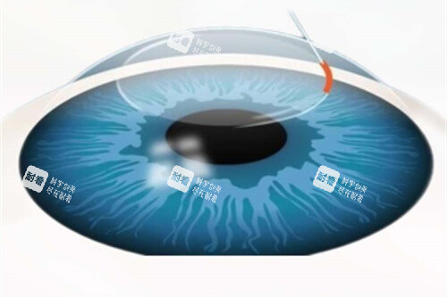 近視矯正眼球漫畫示意圖