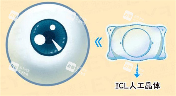 ICL人工晶體圖示