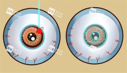 近視手術(shù)不同種類的眼球表現(xiàn)