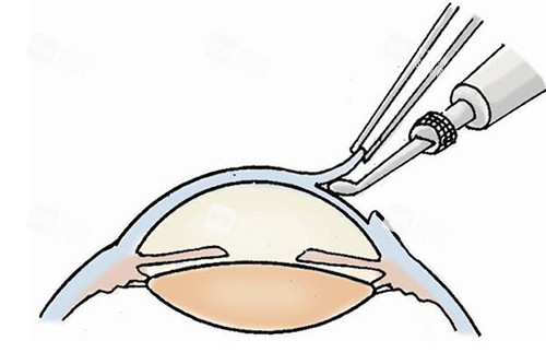 近視手術(shù)改善卡通圖
