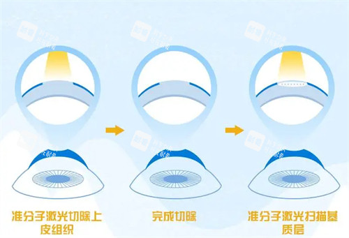 不同的近視手術(shù)