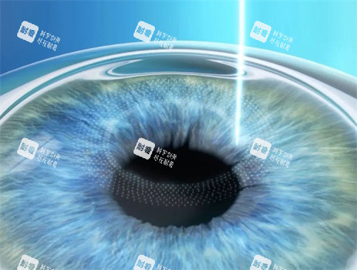 全激光近視手術(shù)