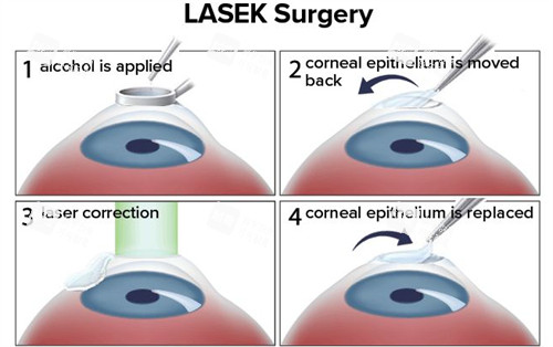 近視手術(shù)過程