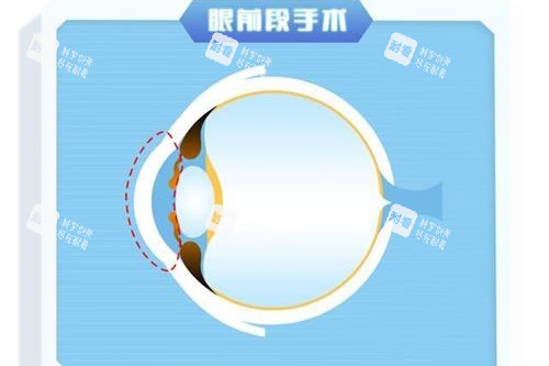 眼前段近視手術示意圖