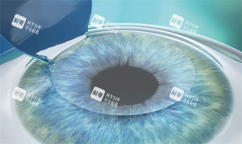 近視手術制瓣中