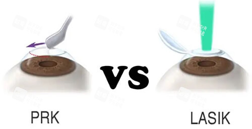 PRK近視手術對比LASIK近視手術漫畫圖