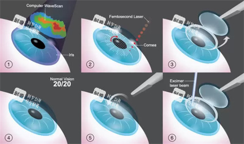 近視手術的流程圖