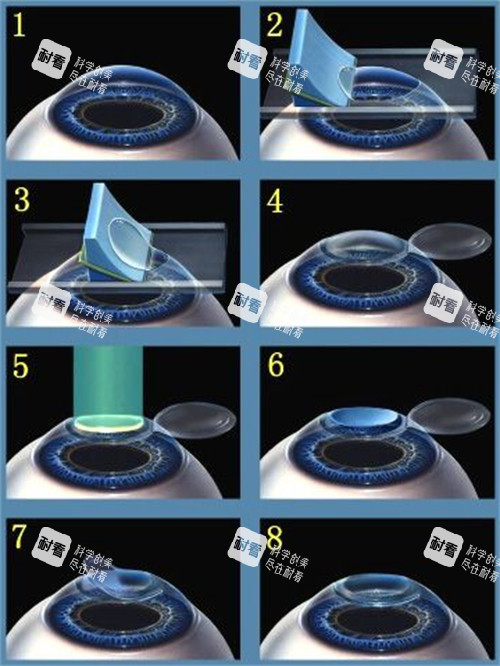 近視手術的手術過程