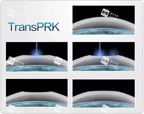 TPRK近視手術示意圖