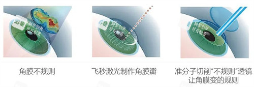 個性化微飛秒手術(shù)與傳統(tǒng)近視手術(shù)的區(qū)別圖解