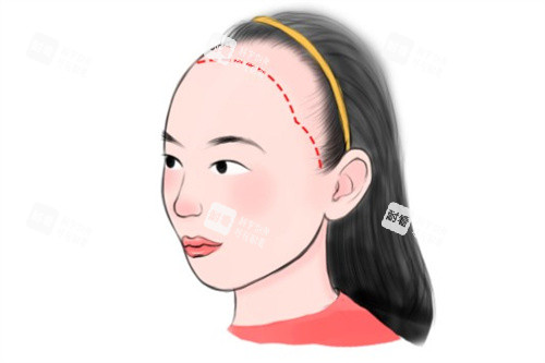 女型發(fā)際線種植卡通