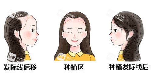 發(fā)際線后遺種植前后