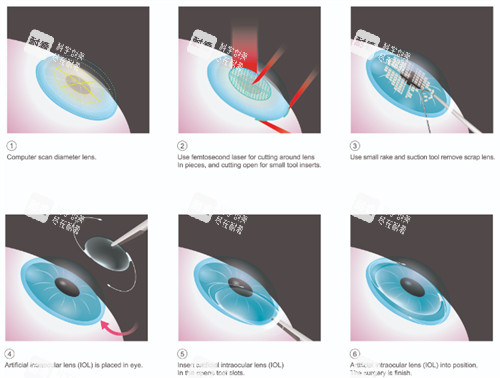 近視晶體植入中