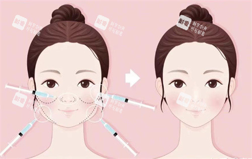 針劑注射打造幼態(tài)臉