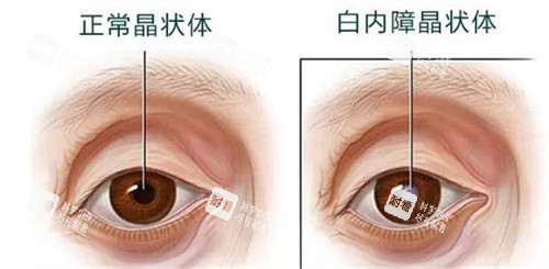 正常晶狀體和白內(nèi)障晶狀體 正常晶狀體和白內(nèi)障晶狀體