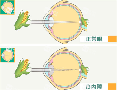 屈光性白內(nèi)障 屈光性白內(nèi)障