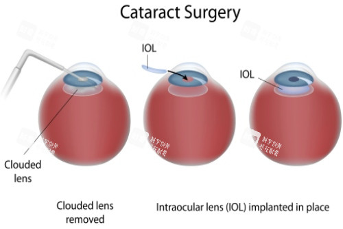 白內(nèi)障晶體植入手術(shù) 白內(nèi)障晶體植入手術(shù)