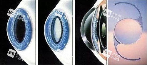 白內(nèi)障晶體手術(shù)細(xì)節(jié)圖 白內(nèi)障晶體手術(shù)細(xì)節(jié)圖