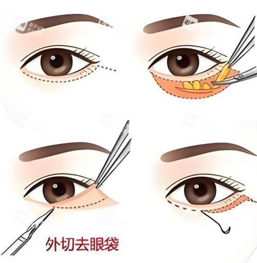 外切去眼袋演示動畫圖