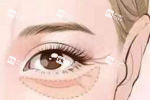 眼袋整形卡通圖