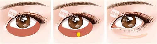 激光祛眼袋術(shù)過程