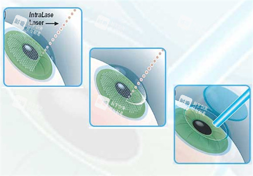 近視手術(shù)過(guò)程圖解
