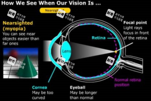 近視眼球結(jié)構(gòu)