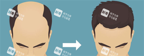 種發(fā)際線前后對(duì)比