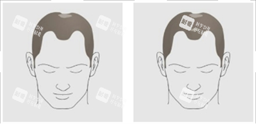 發(fā)際線及頭頂頭發(fā)脫落素材