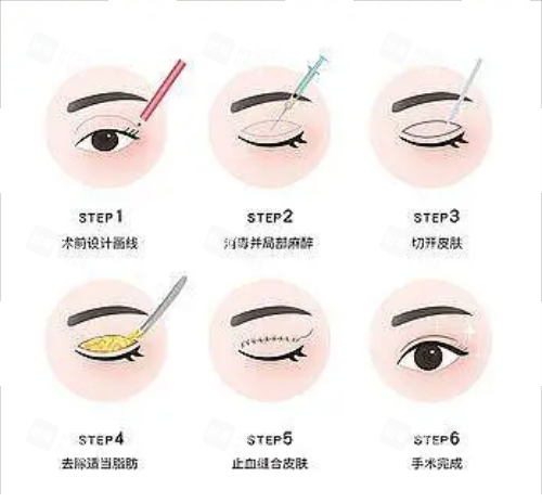 全切雙眼皮流程圖示