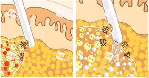 抽脂手術抽脂方式動畫演示圖