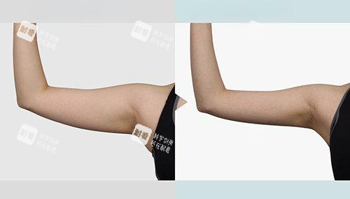 抽脂手術手臂部位前后對比圖