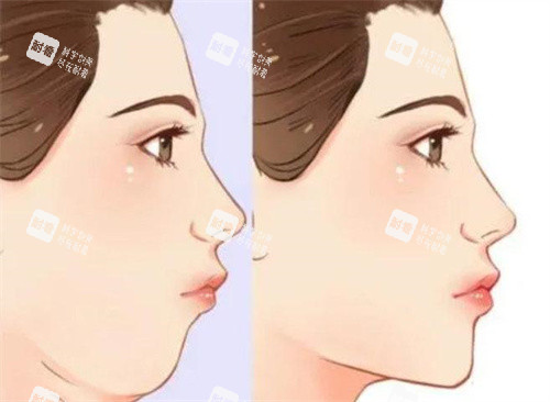 雙下巴抽脂前后對比側(cè)面動畫圖