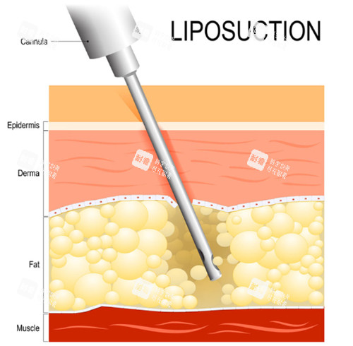 抽脂手術動畫演示