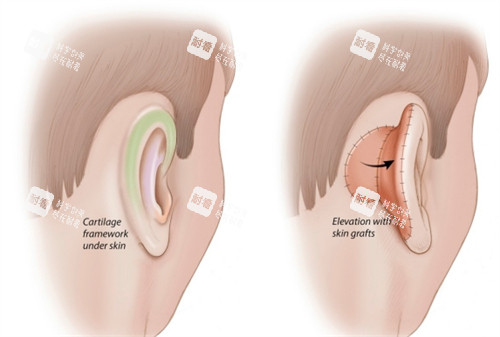 畸形的耳朵對比圖